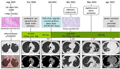 Case report: Recurrent lung infections following treatment with pralsetinib for an elderly patient with RET-fusion positive NSCLC